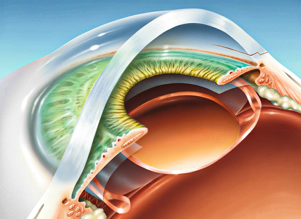 Eye lens clarity and focus support