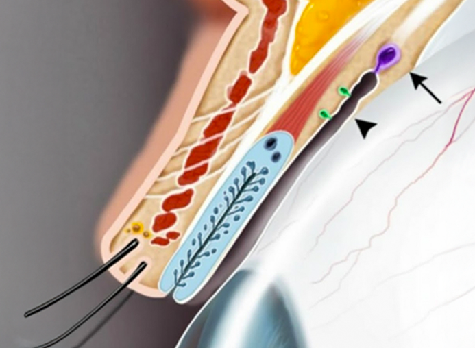 Tear gland support for dry eye relief